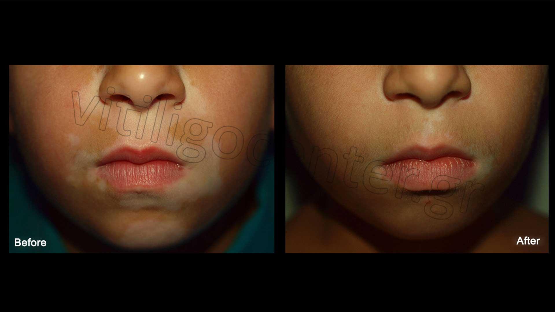 Vitiligo Treatment. How can I cure vitiligo Vitiligo Center